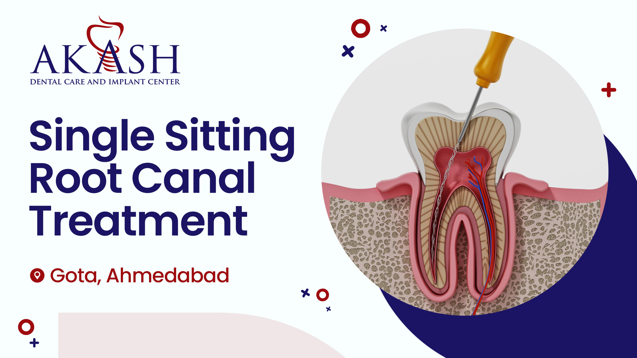 Single Sitting Root Canal Treatment - Akash Dental Care and Implant Center Gota