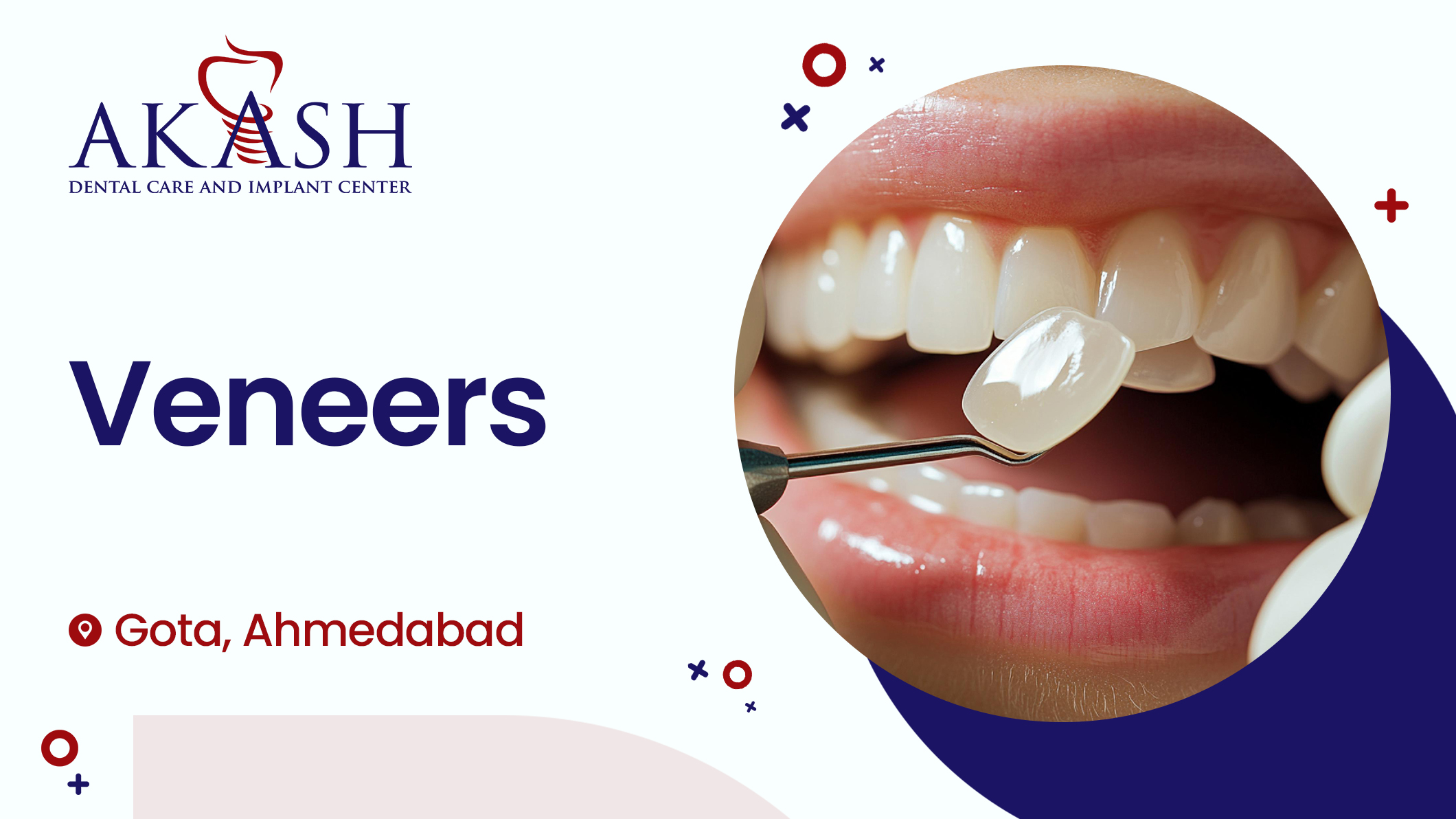 Veneers- Akash Dental Care and Implant Center Gota